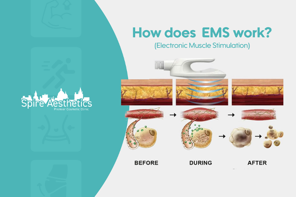 EMS treatment for post pregnancy weight loss treatment Sale