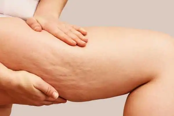 Image of woman showing leg with cellulite Sale