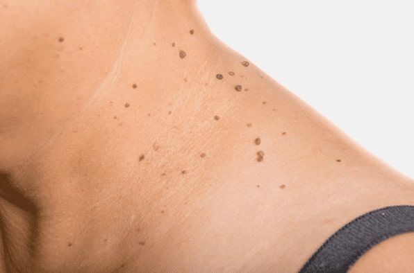 Are you looking for easy skin tag removal Sale - then contact Spire today!
