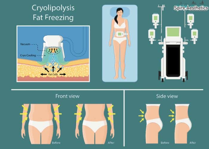 Image of diet and fat freezing combined for best results for Spire Aesthetics Sale