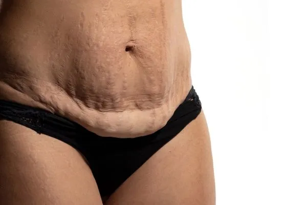Image of womans stomach after weight loss injections Sale showing saggy skin